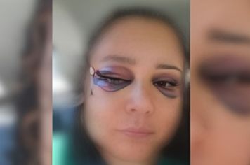 Mulher sofre fraturas no rosto após ser espancada dentro de apartamento