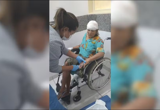 Ataque violento: Idosa é mordida no rosto por pitbull em Pereira Barreto 