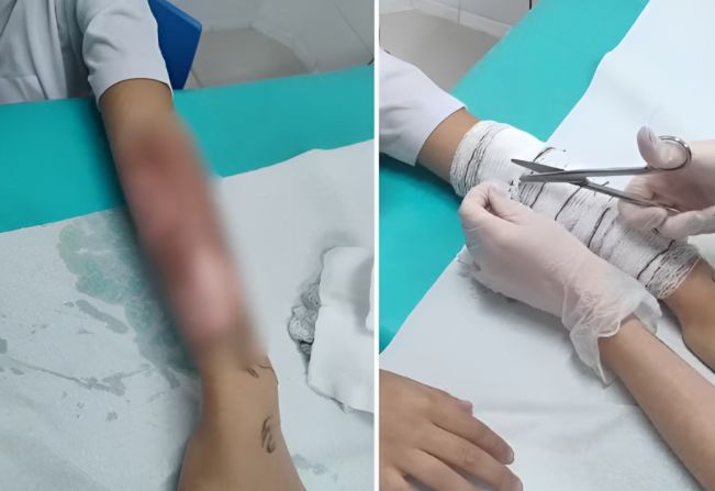 Menino sofre queimadura grave durante experimento escolar com água quente 